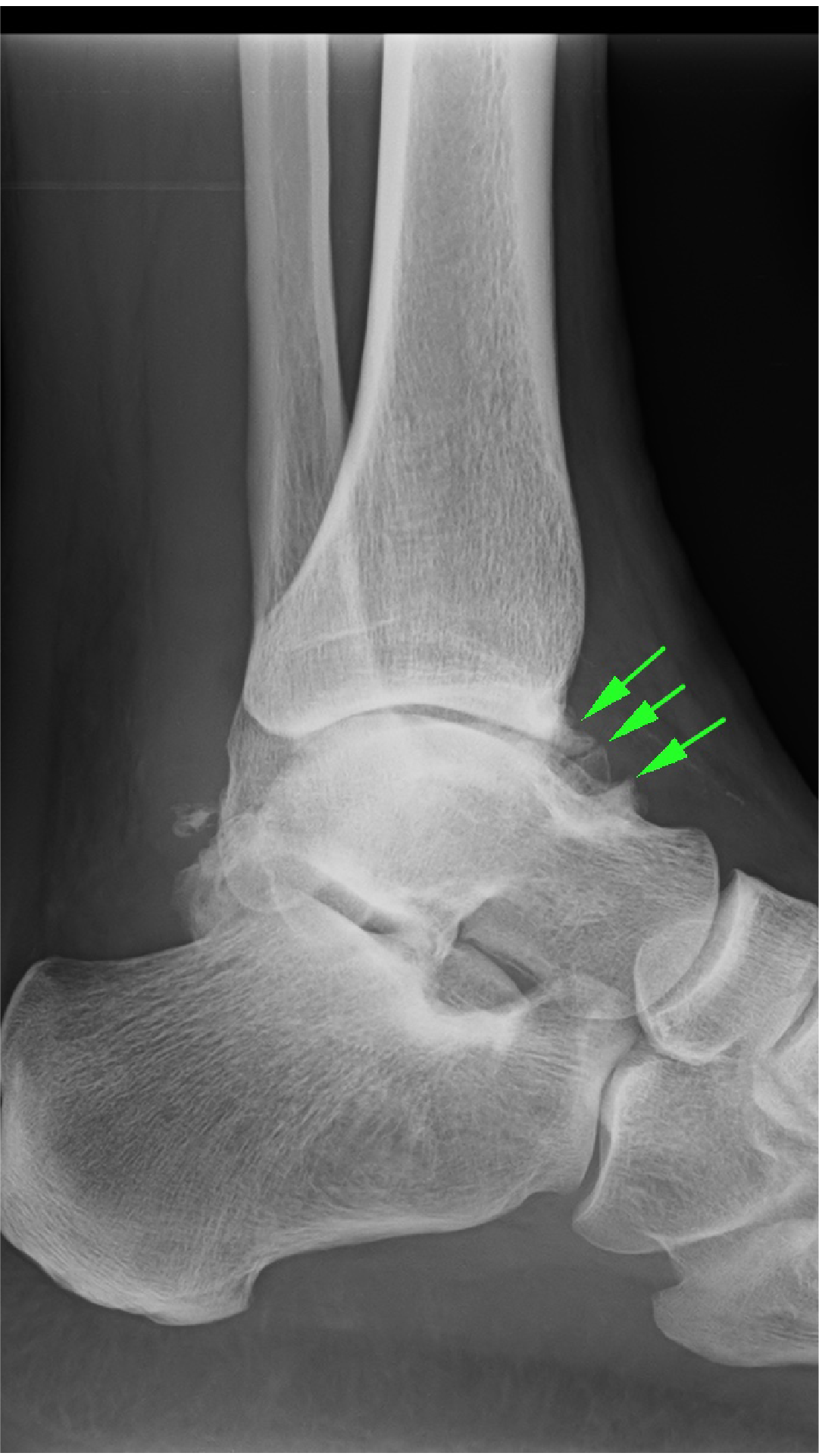 Chronic Ankle Instability Faqs Foot And Ankle Doctor Articles